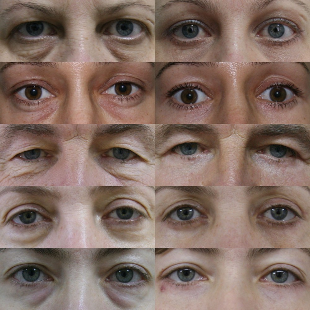 Vorher- und nachher-Bilder einer Frau, die Alterserscheinungen an den Augen auf der linken Seite und ein jüngeres, erfrischtes Aussehen mit reduzierten Falten und Schlupflidern auf der rechten Seite zeigt.